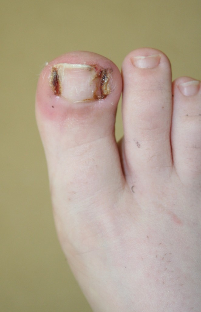 Infected Ingrown Toenail and Granuloma Treatment & Removal