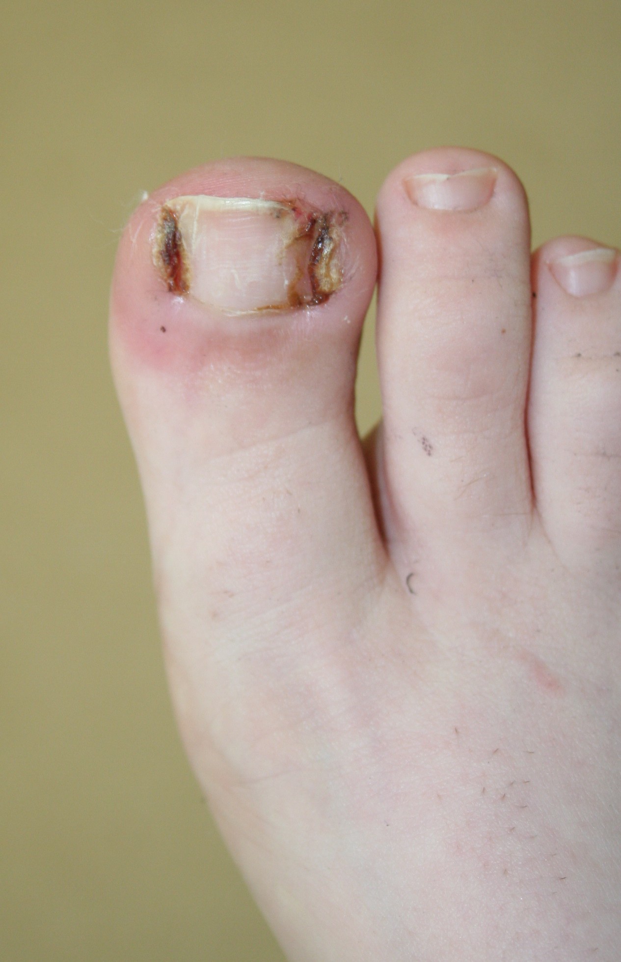 Ingrown Toe Nail Removal And Treatment Doctor Chicago,iL